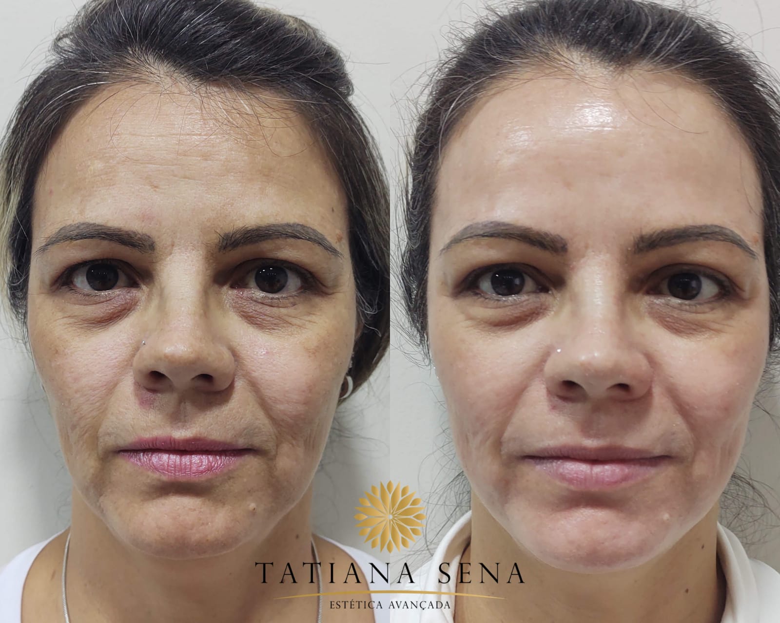 peeling6d-tratamento-melasma (2)