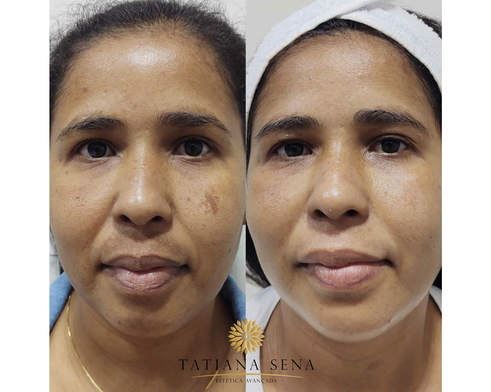 peeling6d-tratamento-melasma8