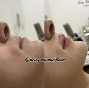 clinica-florpele-campinas-antes-depois (1)