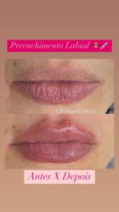 clinica-florpele-campinas-antes-depois (11)