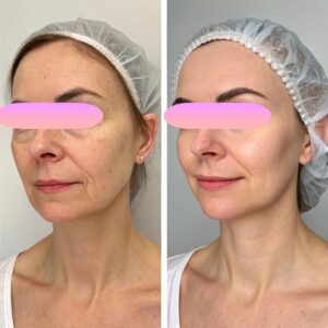 clinica-florpele-campinas-antes-depois (13)