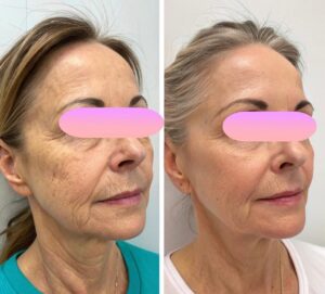 clinica-florpele-campinas-antes-depois (15)