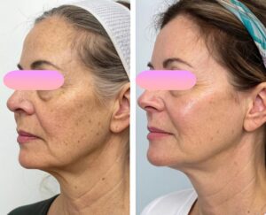 clinica-florpele-campinas-antes-depois (17)