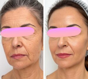 clinica-florpele-campinas-antes-depois (19)