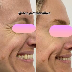 clinica-florpele-campinas-antes-depois (2)