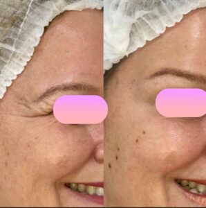 clinica-florpele-campinas-antes-depois (21)