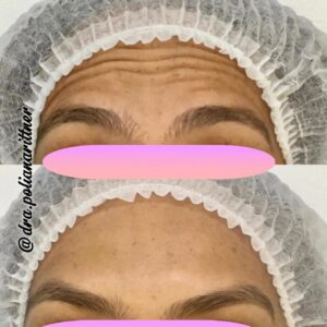 clinica-florpele-campinas-antes-depois (23)