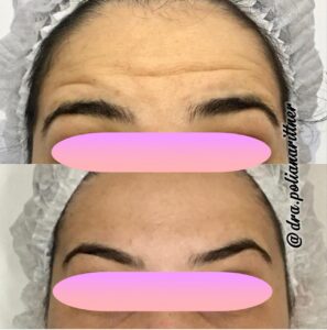 clinica-florpele-campinas-antes-depois (24)