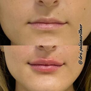 clinica-florpele-campinas-antes-depois (25)