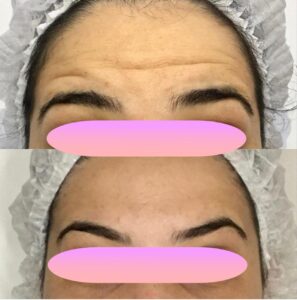 clinica-florpele-campinas-antes-depois (28)