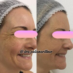 clinica-florpele-campinas-antes-depois (29)