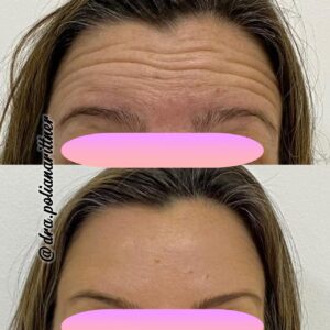 clinica-florpele-campinas-antes-depois (3)