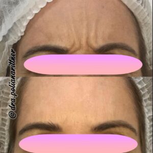 clinica-florpele-campinas-antes-depois (30)