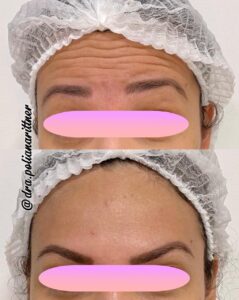 clinica-florpele-campinas-antes-depois (31)