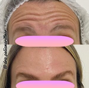 clinica-florpele-campinas-antes-depois (33)