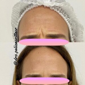 clinica-florpele-campinas-antes-depois (34)