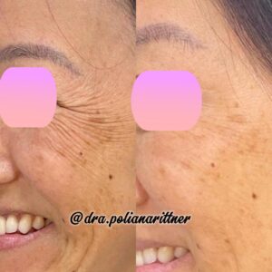 clinica-florpele-campinas-antes-depois (4)