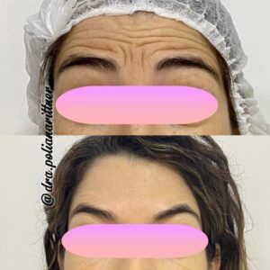 clinica-florpele-campinas-antes-depois (5)