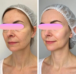 clinica-florpele-campinas-antes-depois (6)