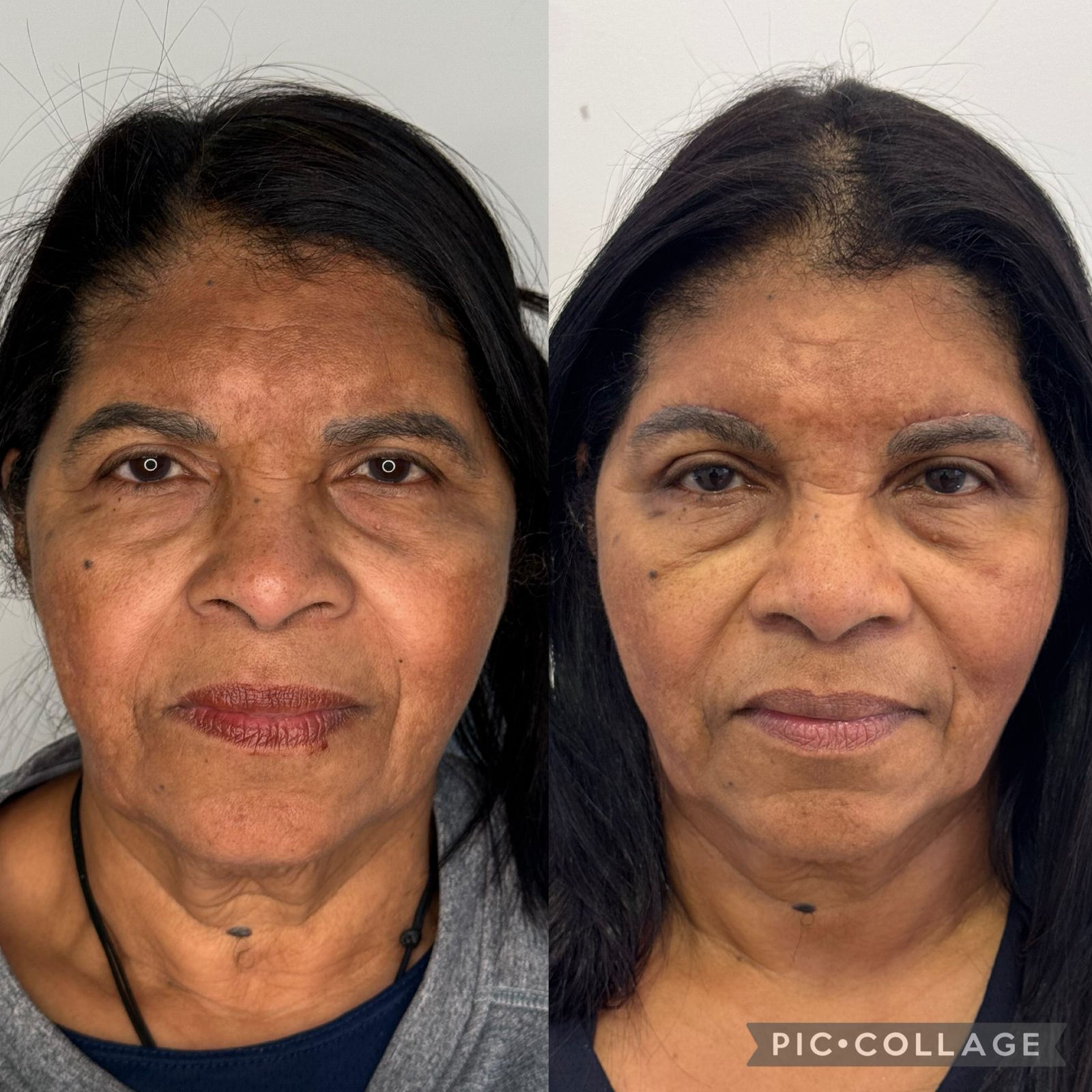 blefaroplastia-vitoria-espirito-santo-consultorio