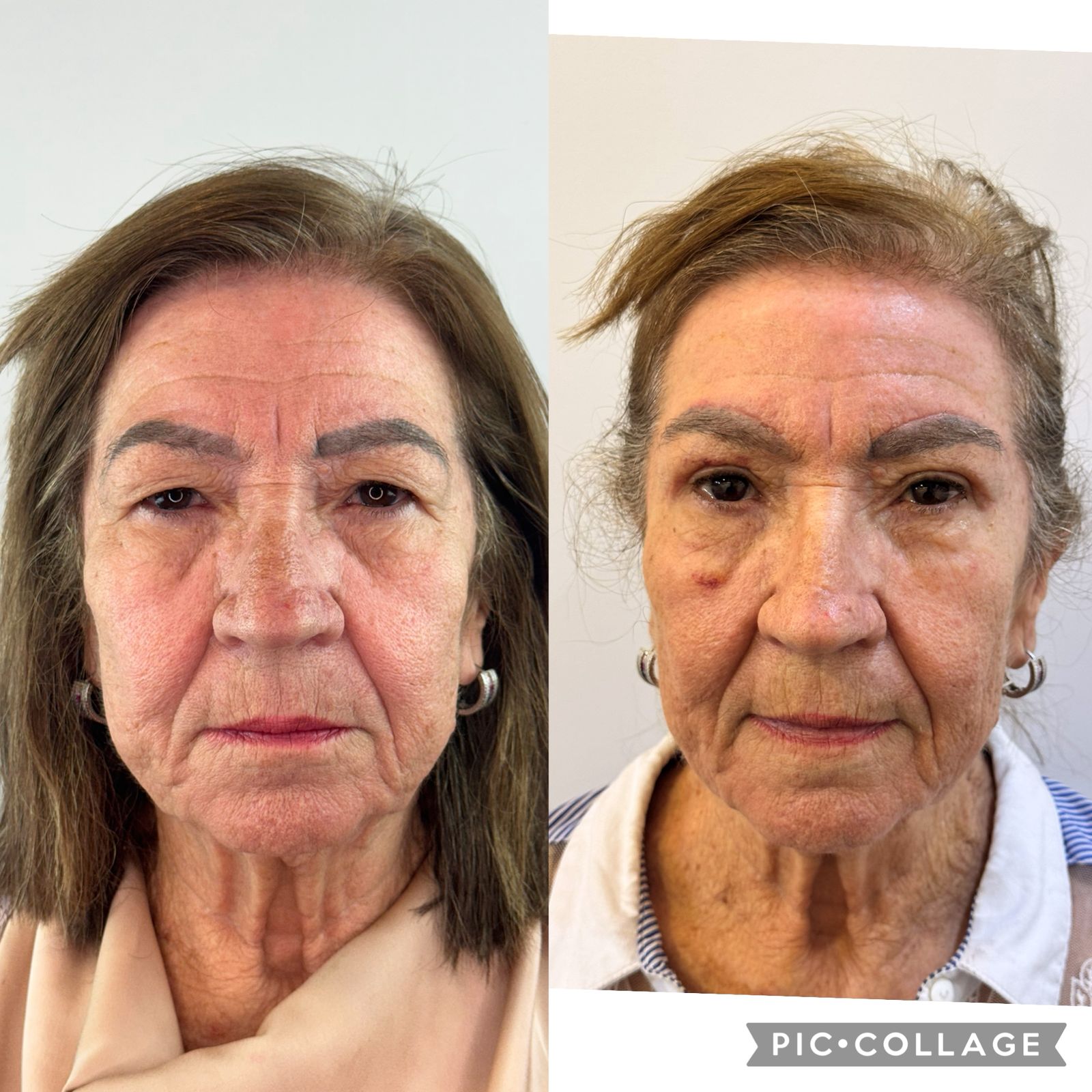 blefaroplastia-vitoria-espirito-santo-consultorio1