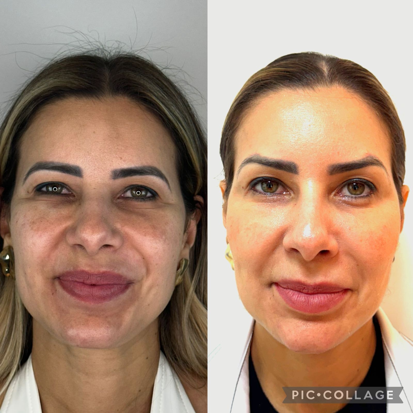 blefaroplastia-vitoria-espirito-santo-consultorio10