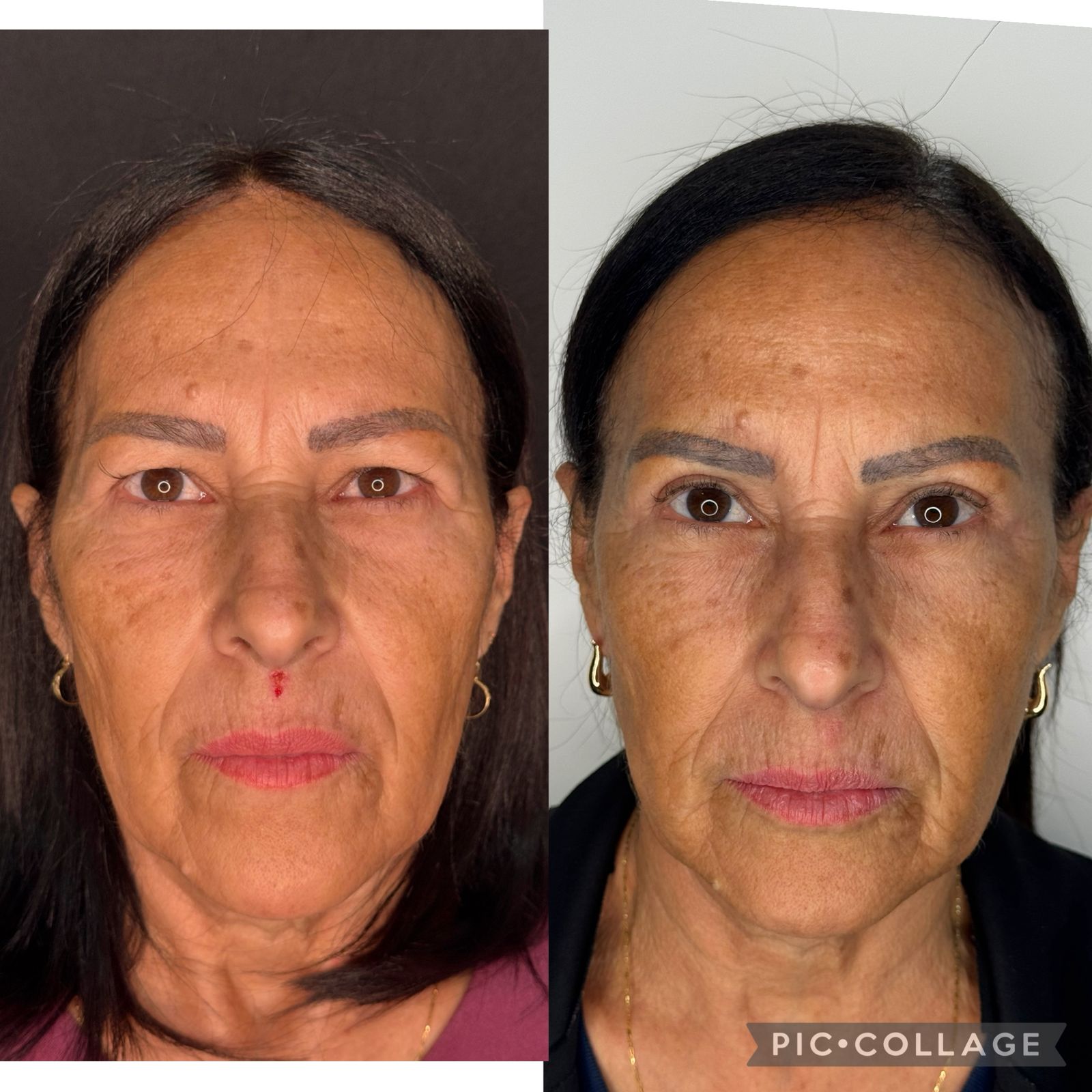 blefaroplastia-vitoria-espirito-santo-consultorio2