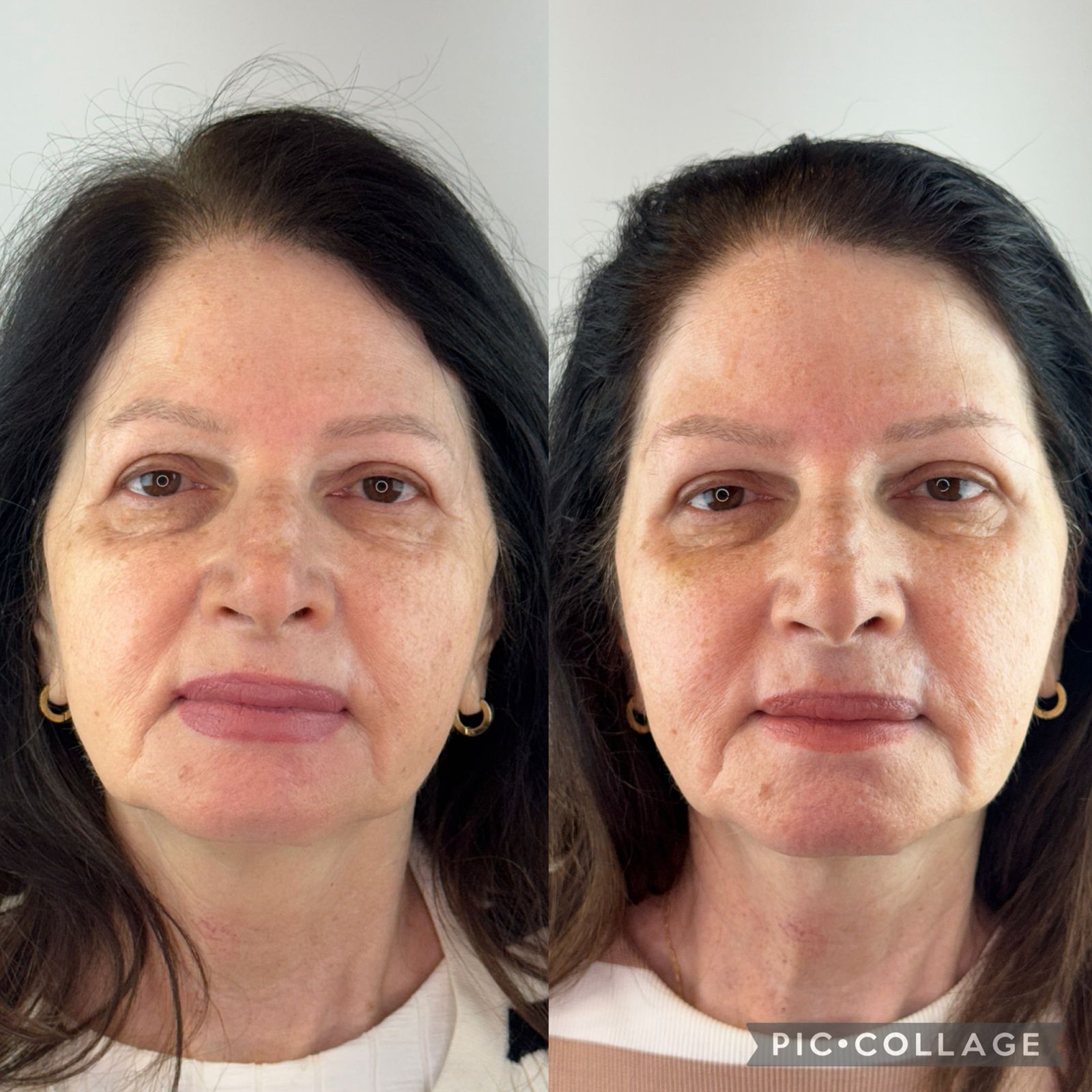 blefaroplastia-vitoria-espirito-santo-consultorio3