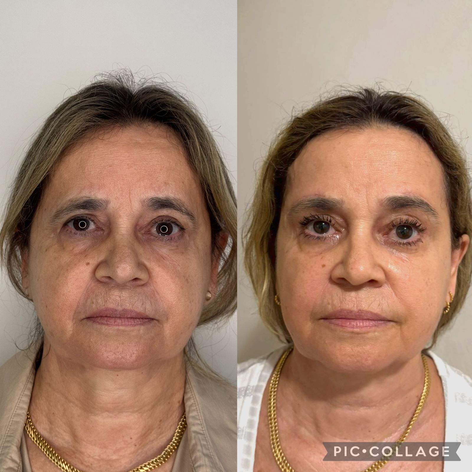 blefaroplastia-vitoria-espirito-santo-consultorio6