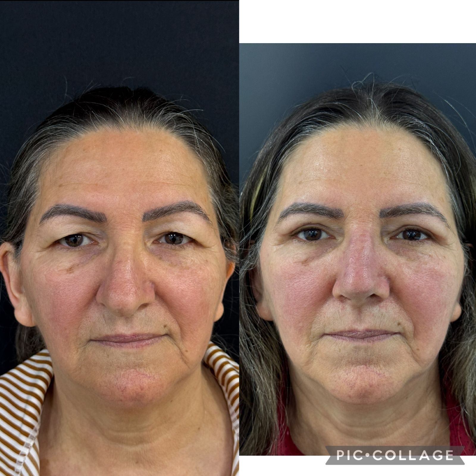 blefaroplastia-vitoria-espirito-santo-consultorio7