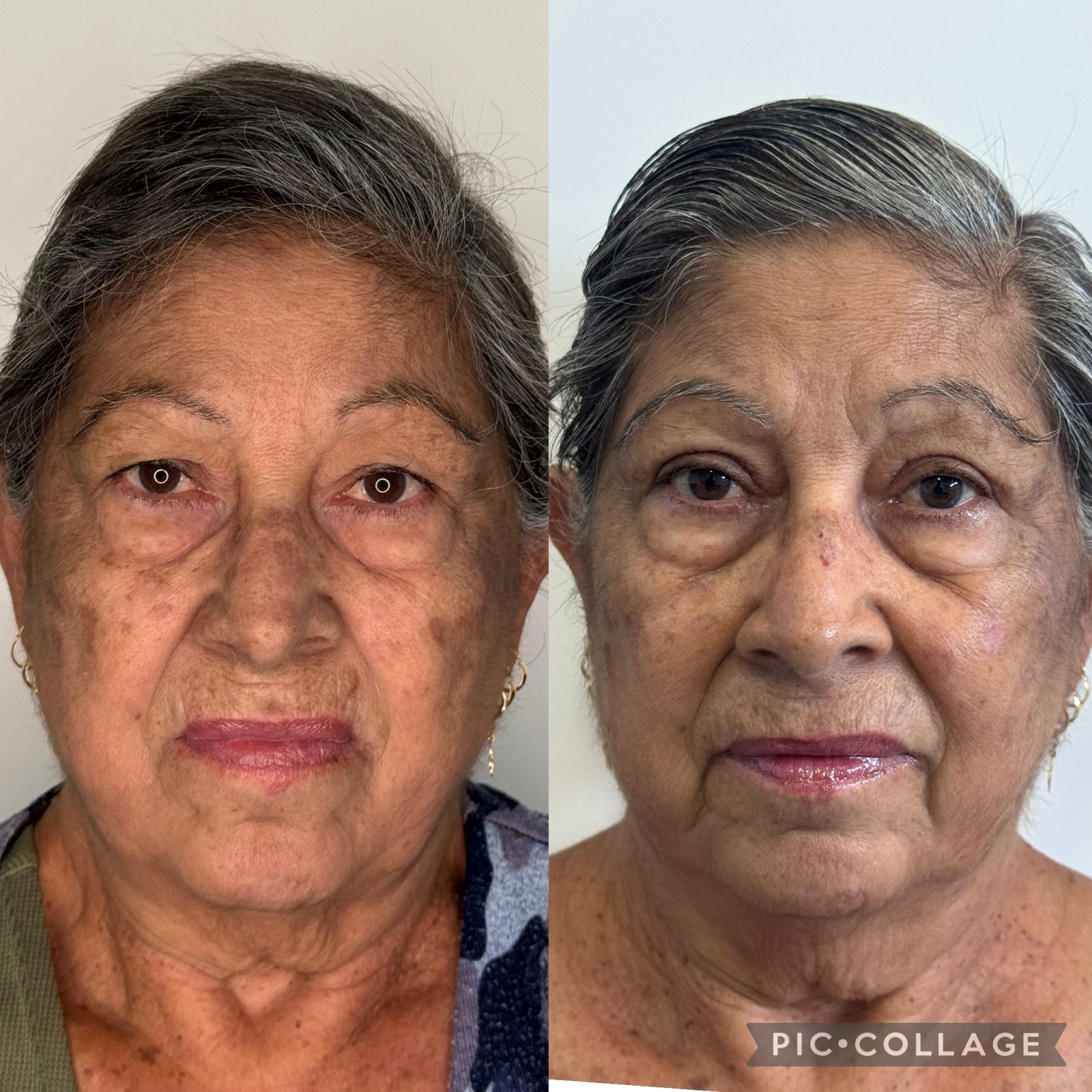 blefaroplastia-vitoria-espirito-santo-consultorio8