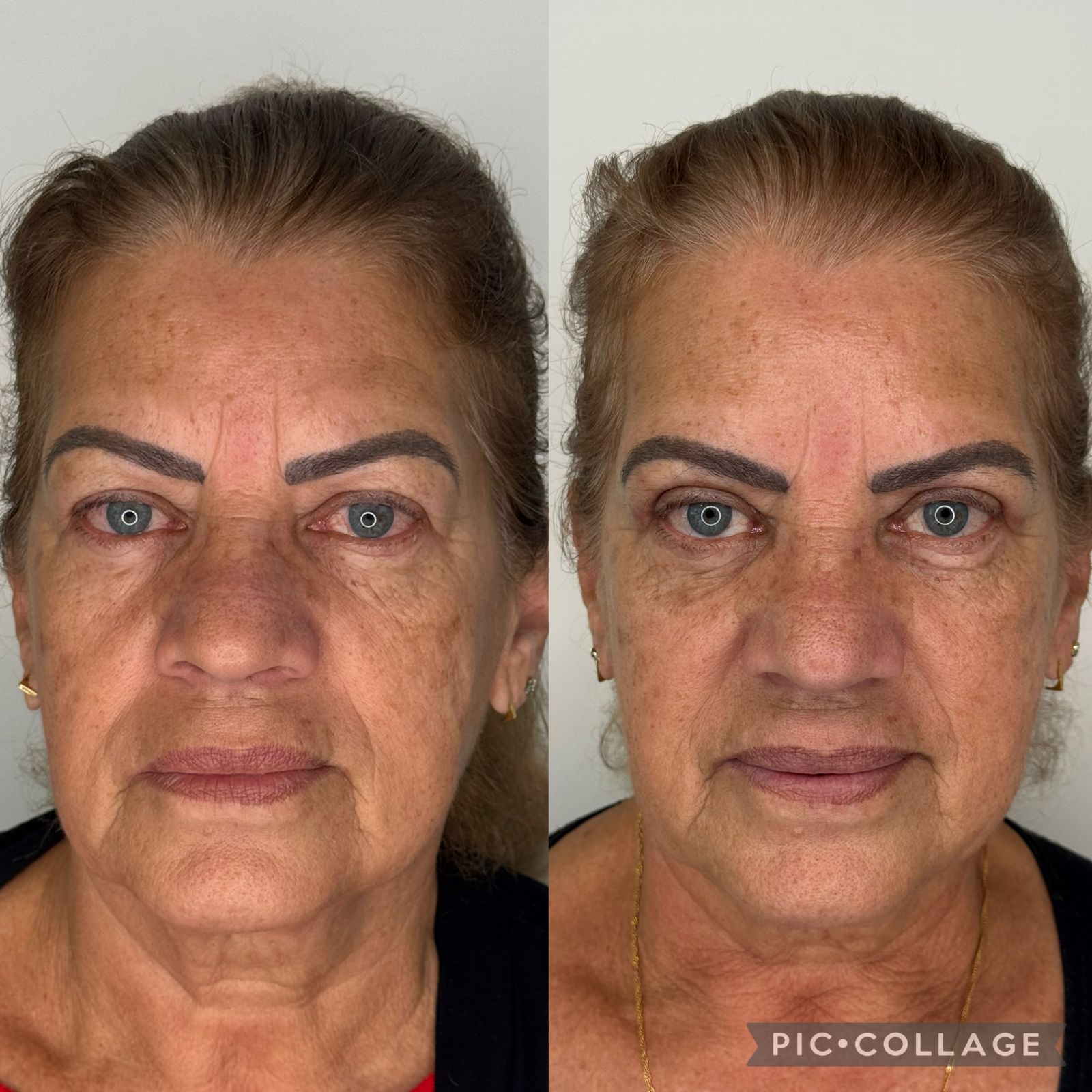 blefaroplastia-vitoria-espirito-santo-consultorio9