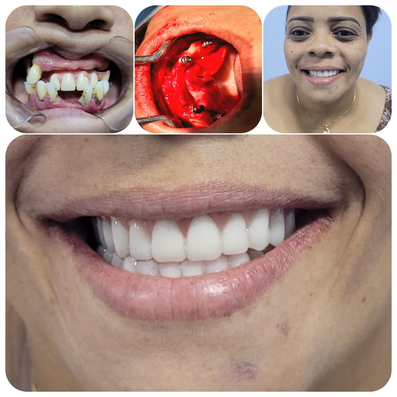 implantes-dentarios-protocolosfixos-vitoria-es (10)