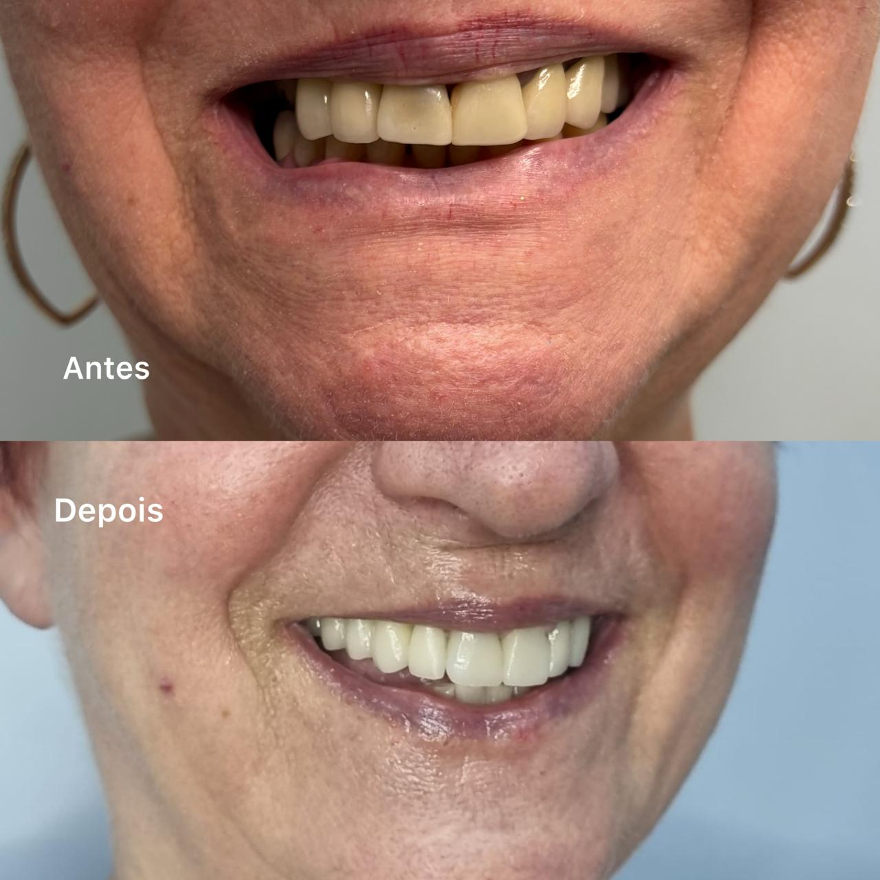 implantes-dentarios-protocolosfixos-vitoria-es (13)