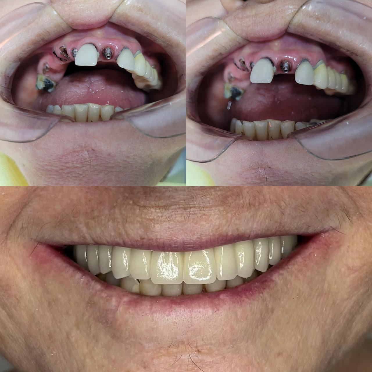 implantes-dentarios-protocolosfixos-vitoria-es (3)