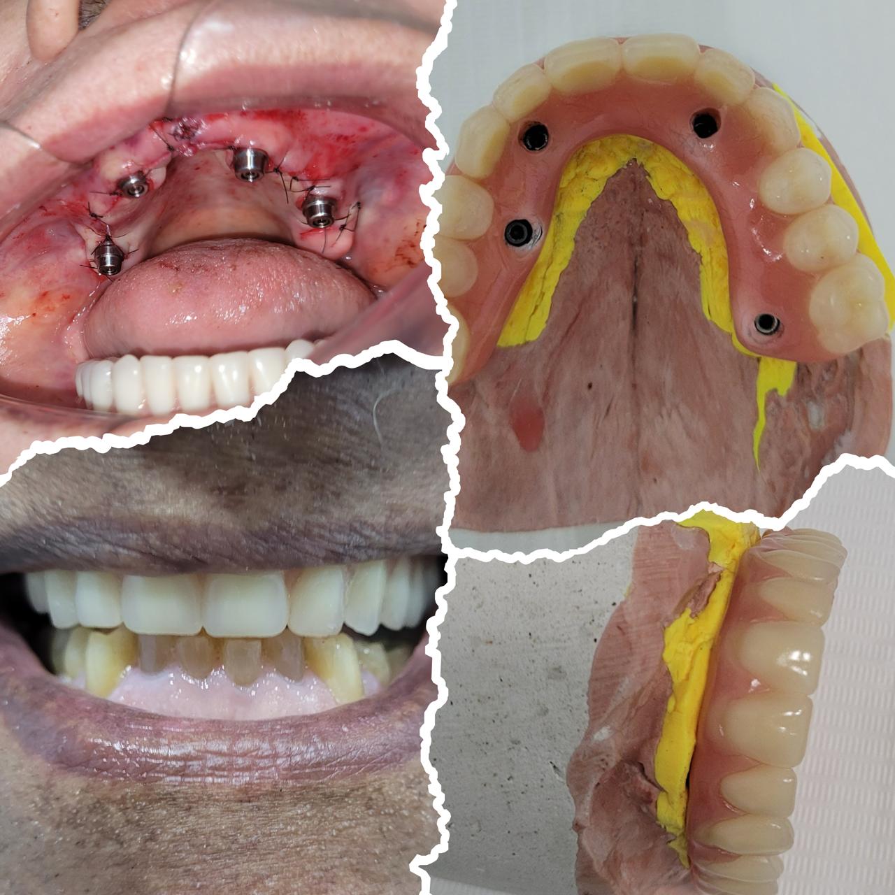 implantes-dentarios-protocolosfixos-vitoria-es (4)
