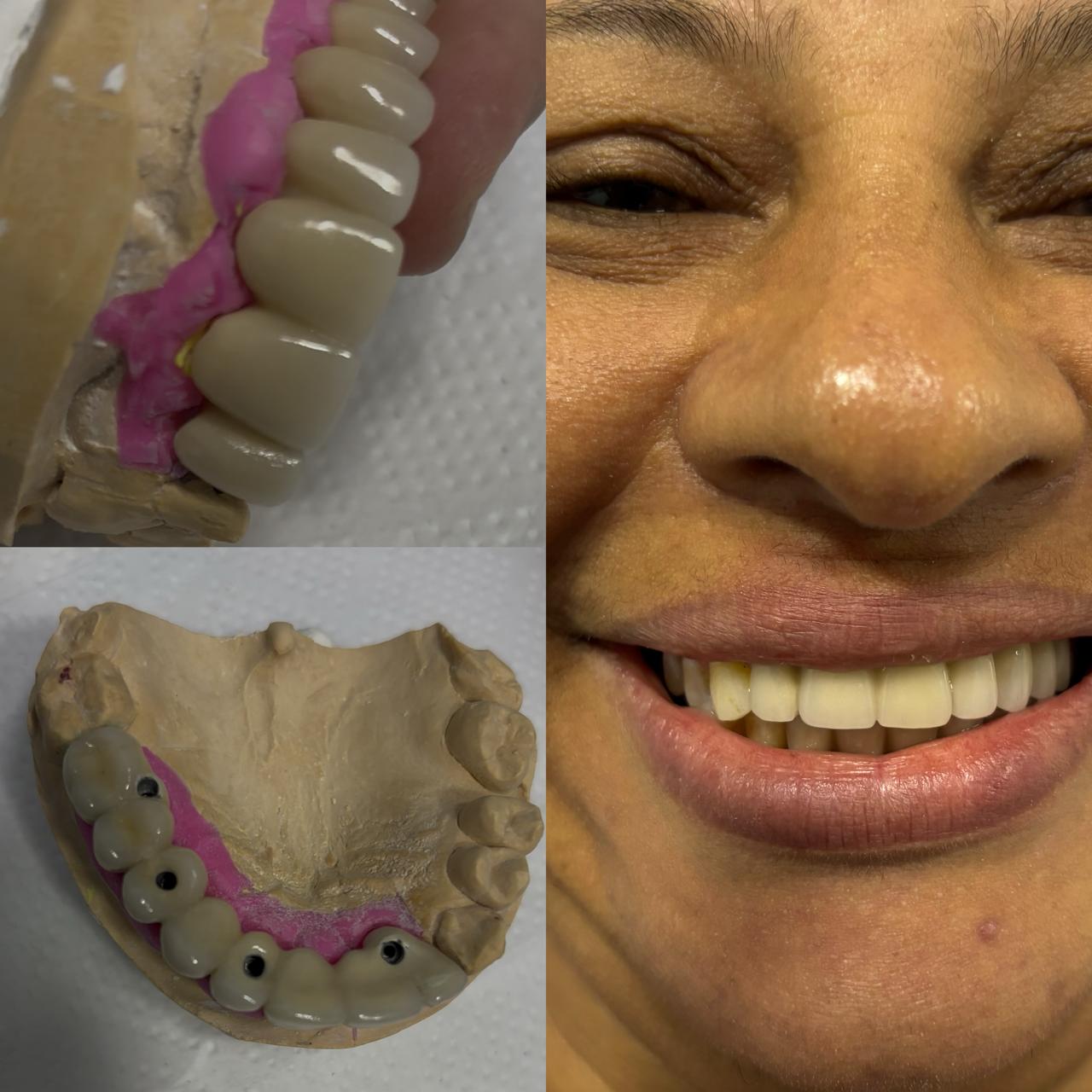 implantes-dentarios-protocolosfixos-vitoria-es (5)