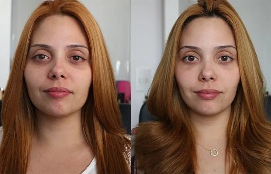 acido-hialuronico-beleza-pele-recuperacao acido-hialuronico-beleza-pele-recuperacao
